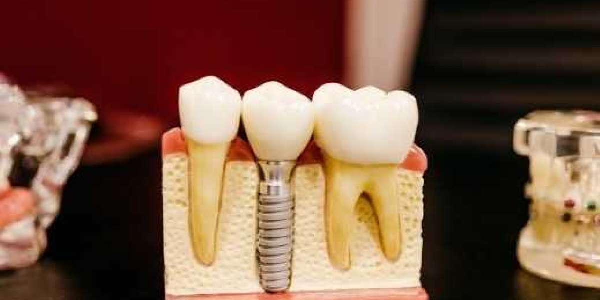 Transform Your Smile With Dental Implants In Malvern
